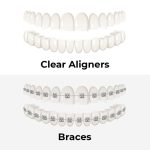 Teeth alignment options (braces vs clear aligners)